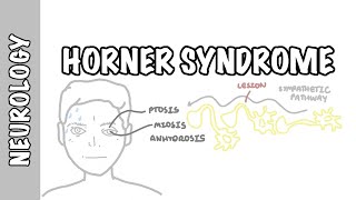 Horner Syndrome  anatomy causes pathophysiology investigation [upl. by Nolly391]