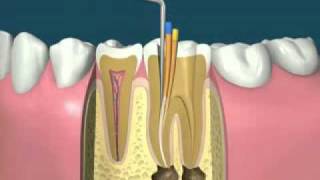 traitement endodontiquedevitalisationflv [upl. by Yeniffit]