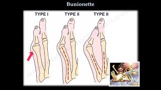 Bunionette  Everything You Need To Know  Dr Nabil Ebraheim [upl. by Rosie]