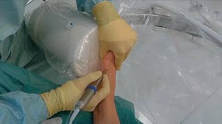 New Less Invasive Bunion Surgery [upl. by Edlin]