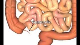 Appendectomy Surgery for Appendicitis removal of appendix [upl. by Paolo705]