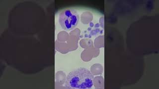 Low Platelets Signs amp Symptoms Basics for Beginners [upl. by Letram]