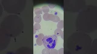 Platelet Count Test  Procedure Importance and Normal Range [upl. by Neirod]