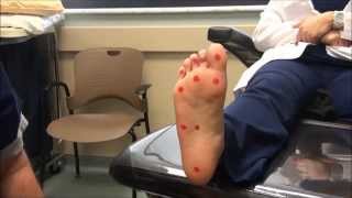 Neurologic Examination of the Foot 10gm Monofilament Test [upl. by Zinck539]