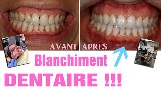 Blanchiment dentaire  AVANTAPRES Revue 25 [upl. by Tor]