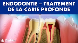 Endodontie  Traitement de la carie profonde © [upl. by Nanoc184]