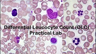 Low Platelets Causes conditions and treatment [upl. by Eelirrem957]