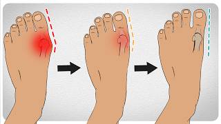 How to Fix Bunions in 5 Steps [upl. by Nehpets86]