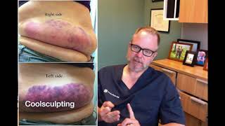 Sculpsure vs Coolsculpting  Which One is Better [upl. by Abshier574]