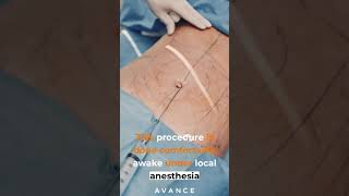 Liposuction procedure [upl. by Hait]