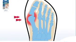 Set Up a Flexible Thumb Brace  Day use  Rhizarthrose  EPITACT® [upl. by Hajed]