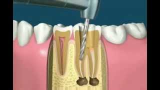 Traitement radiculaire [upl. by Sremmus]
